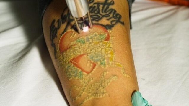 5 In Order To Tattoo Ink Removal