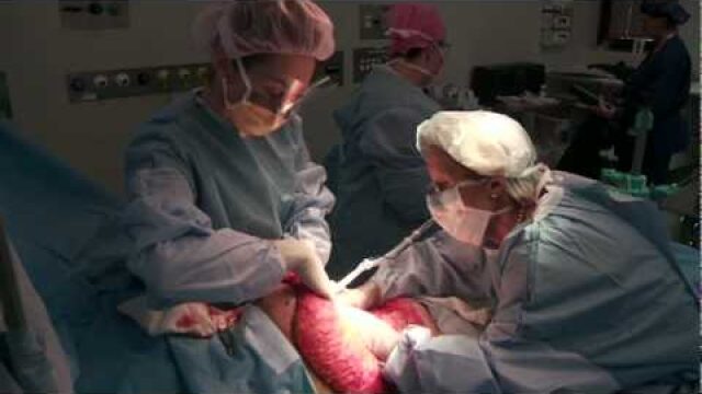 Flat and Fabulous: Unveiling the Secrets of Tummy Tucks