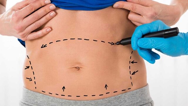 Flatten Your Tummy: Unveiling the Secrets of Abdominoplasty