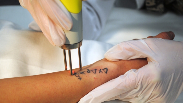 Tattoo Removal – What Methods A Few Obvious Methods