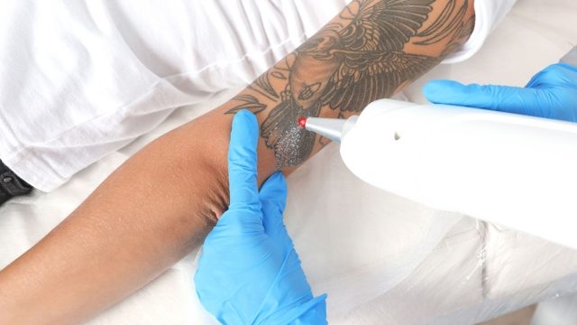 Easy And Safe Tattoo Removal