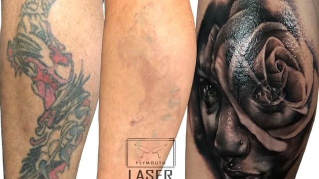 Tattoo Removal Made Easy With Laser Devices